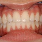 Dental Bleaching