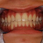 Dental Whitening