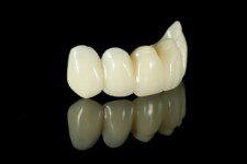 Tooth Veneer